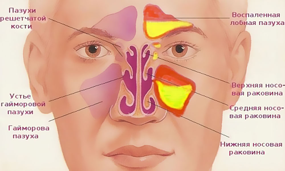 Синусит, гайморит: причины, симптомы и лечение