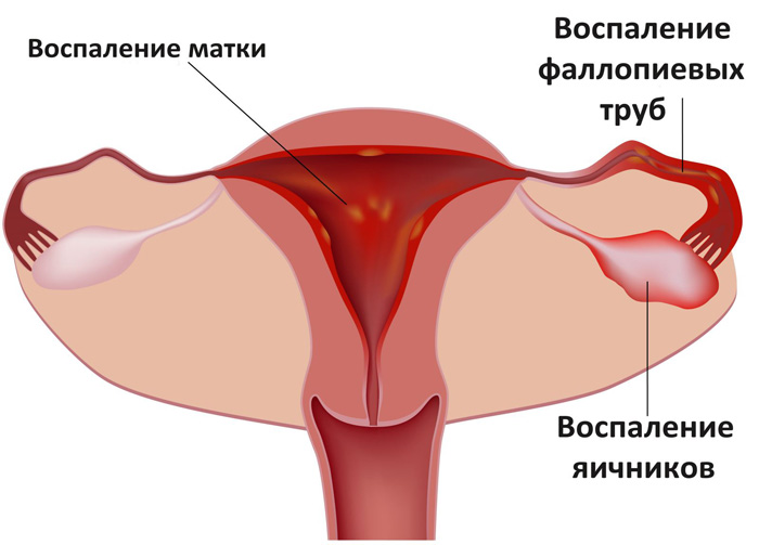 Профилактика эндометрита у женщин 11