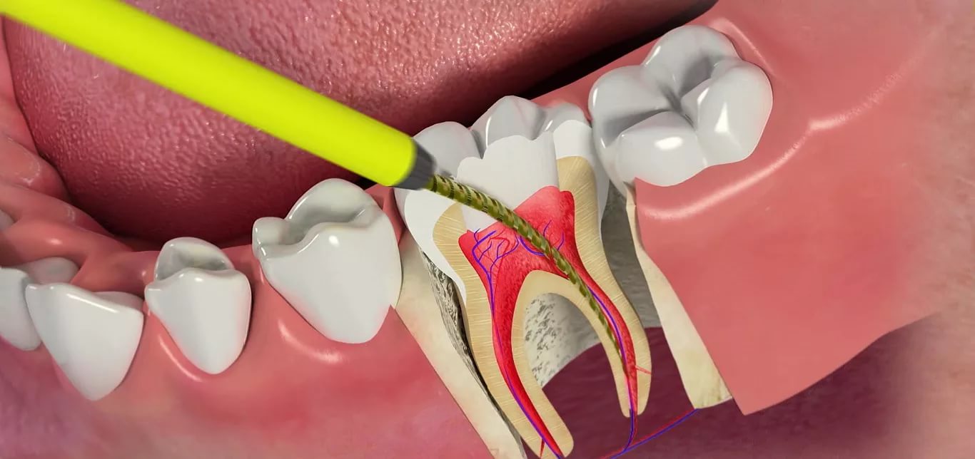 Болит зуб после удаления нерва 