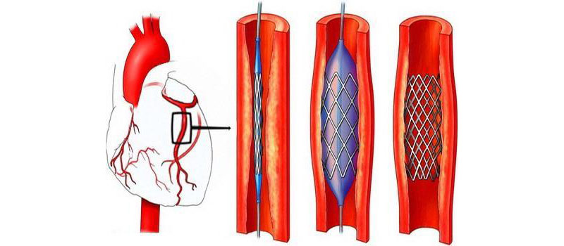 Шунтирование коронарных артерий
