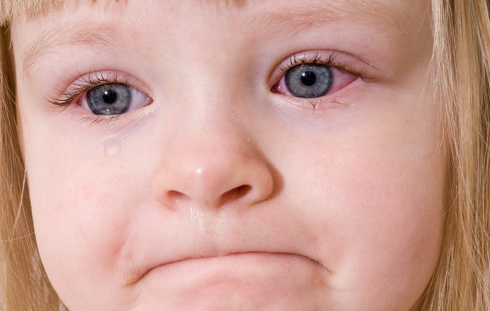 Причины покраснения глаз у детей