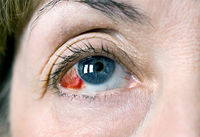 Что делать при кровоизлиянии в глаз