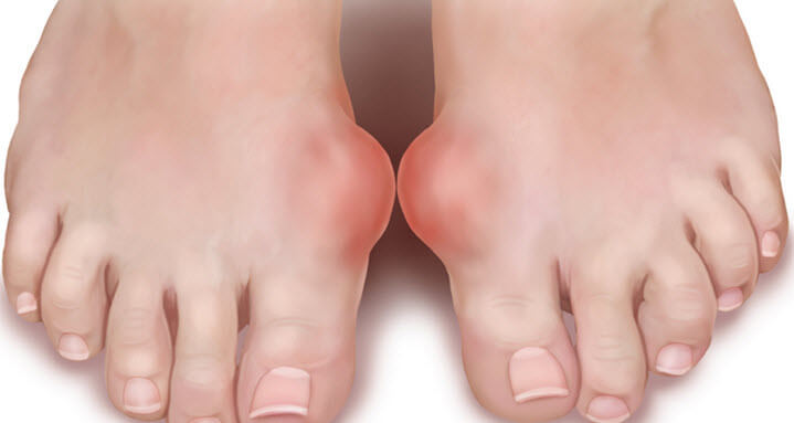 Причины появления косточек на больших пальцах ног