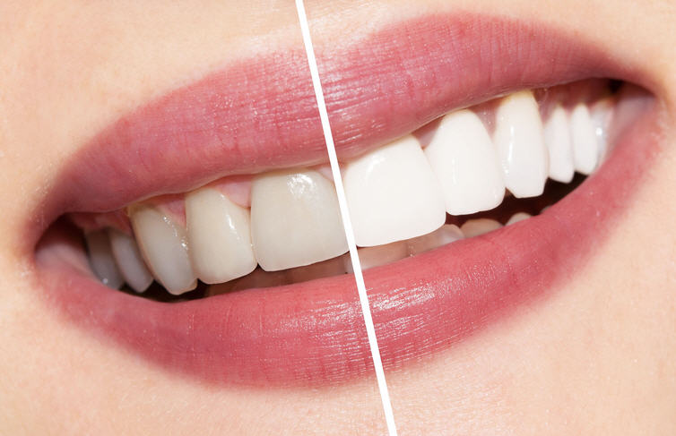 Отбеливание зубов: суть и виды процедур