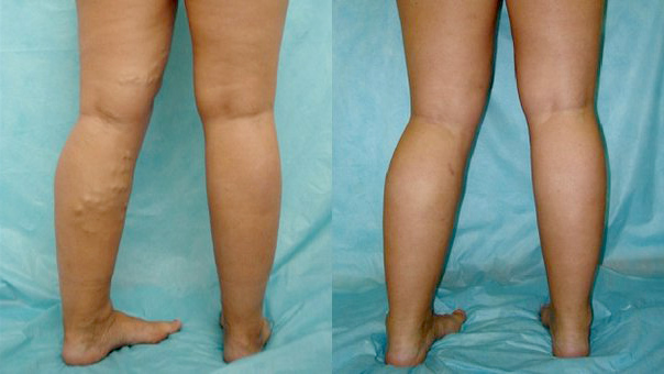 Симптомы тромба в ноге