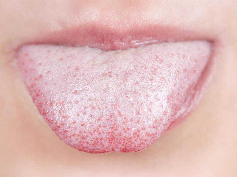 Белый налет на языке от антибиотиков