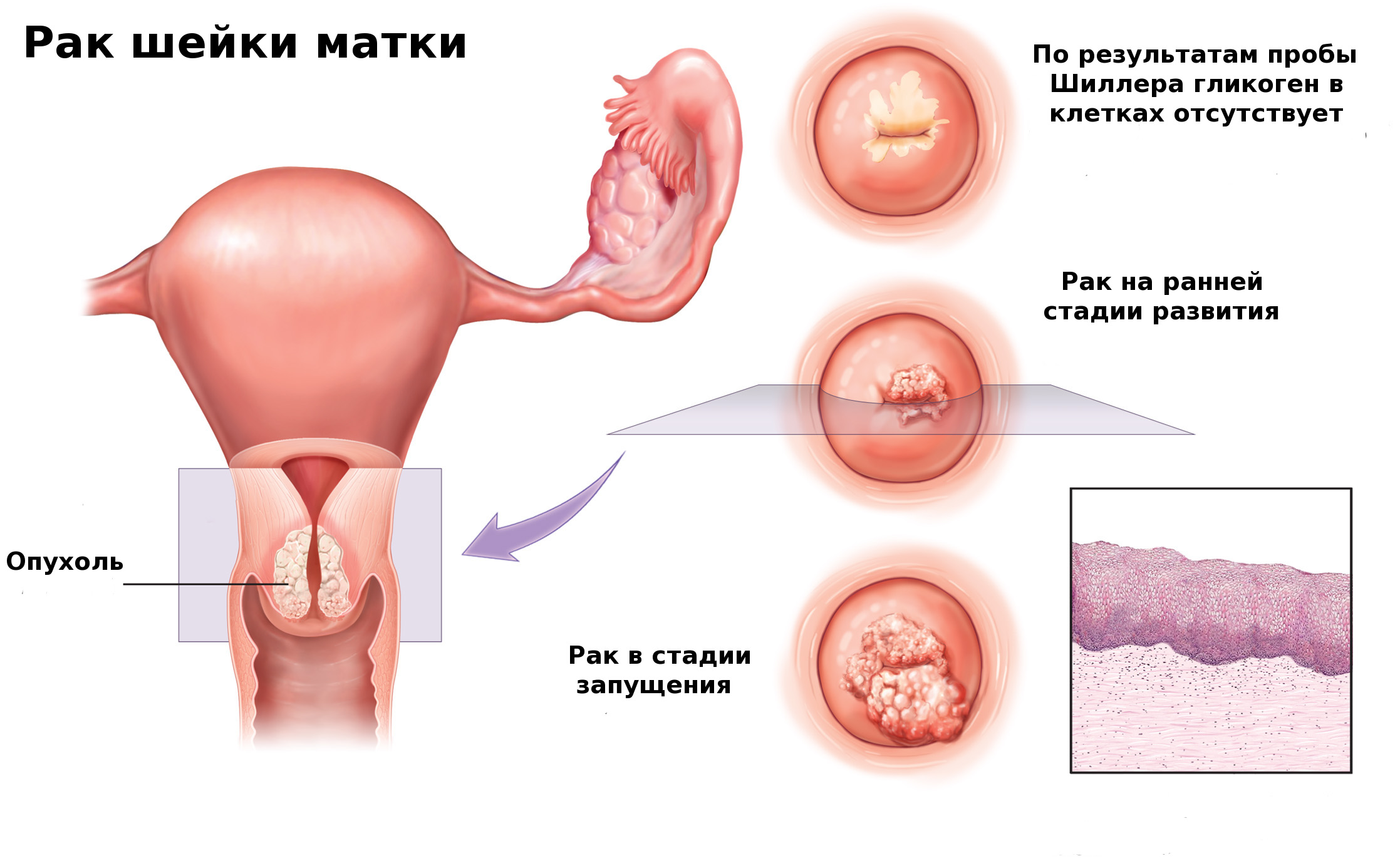 Основные симптомы рака матки