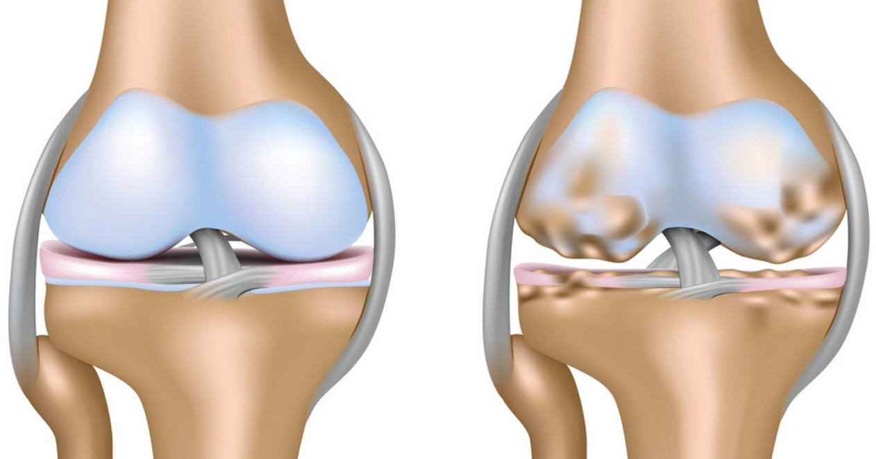 Что такое артроз коленного сустава