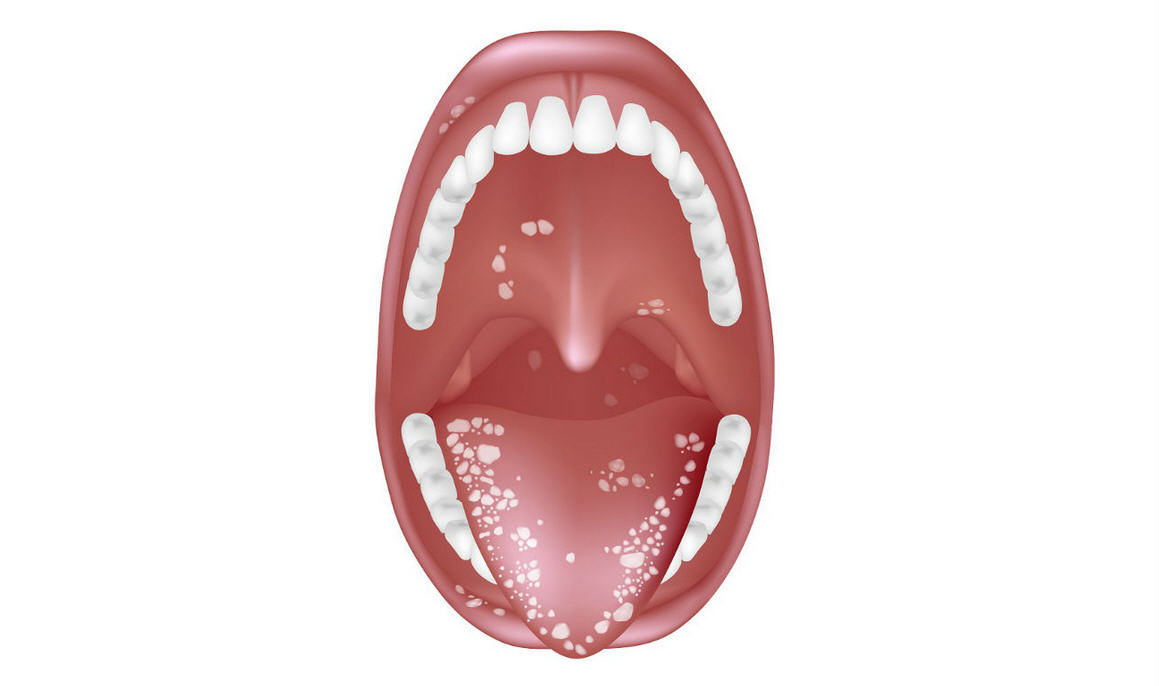 Кандидоз полости рта - симптомы и лечение