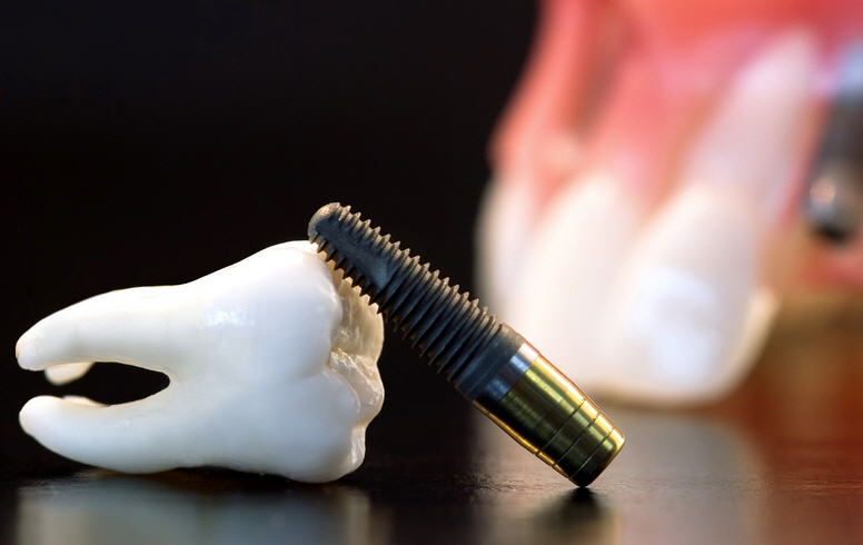 Процедура имплантации зубов: основные преимущества