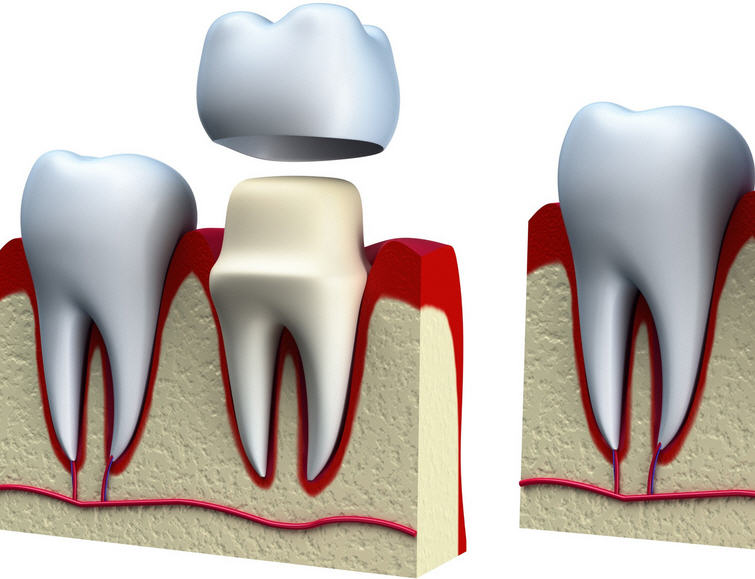 Зубное протезирование. Установка коронок