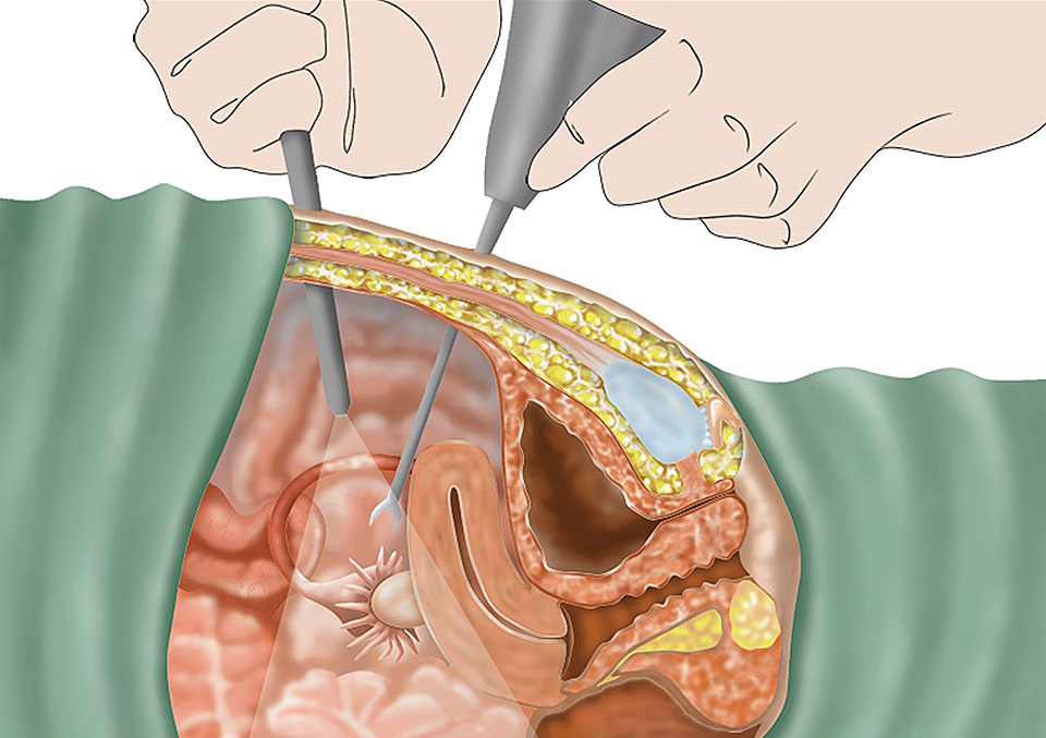 Как проводится лапароскопия по удалению миомы матки