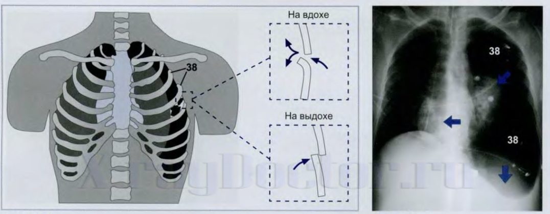 рентгенограмма при клапанном пневмотораксе