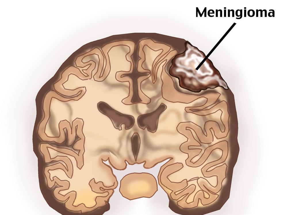 Что такое лобная менингиома