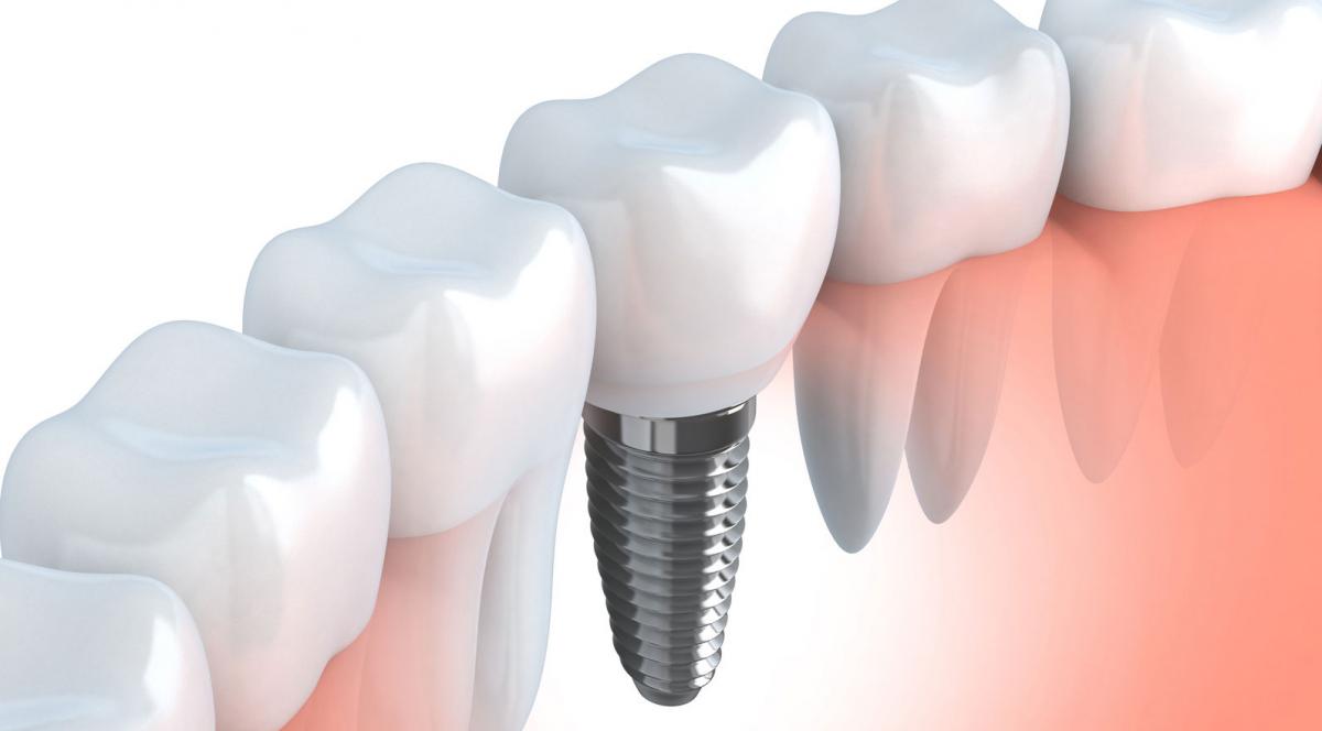 Зубные имплантаты: их разновидности и стоимость установки