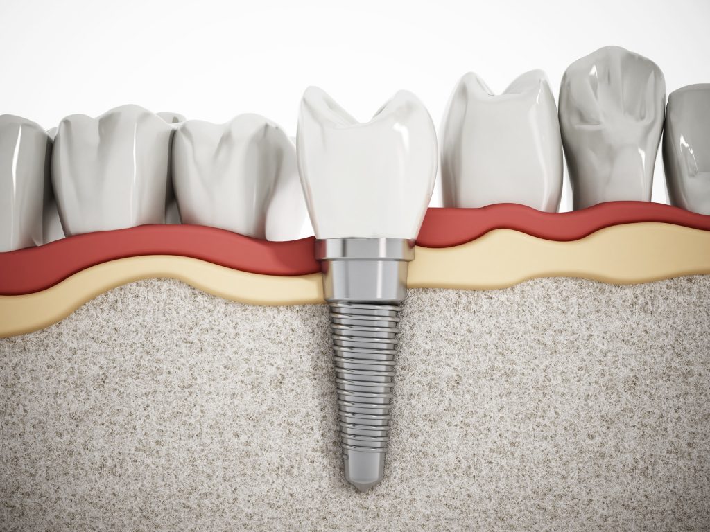 Какие бывают зубные импланты — краткое описание