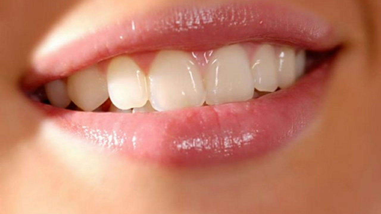Лучшая защита от кариеса: фторирование зубов