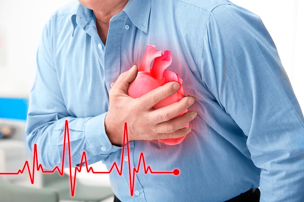 Инфаркт миокарда - симптомы и лечение