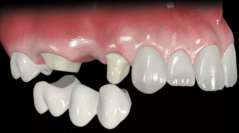 Зубные протезы, их виды и особенности