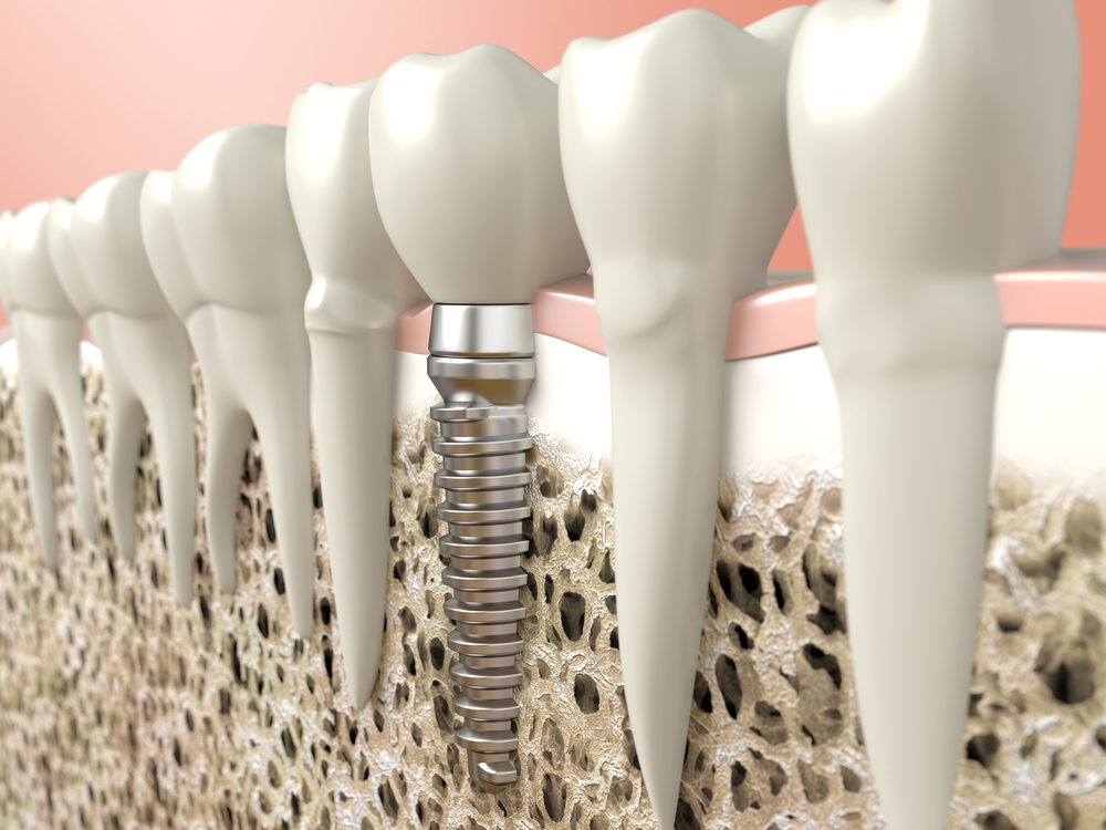 Современный подход к имплантации зубов