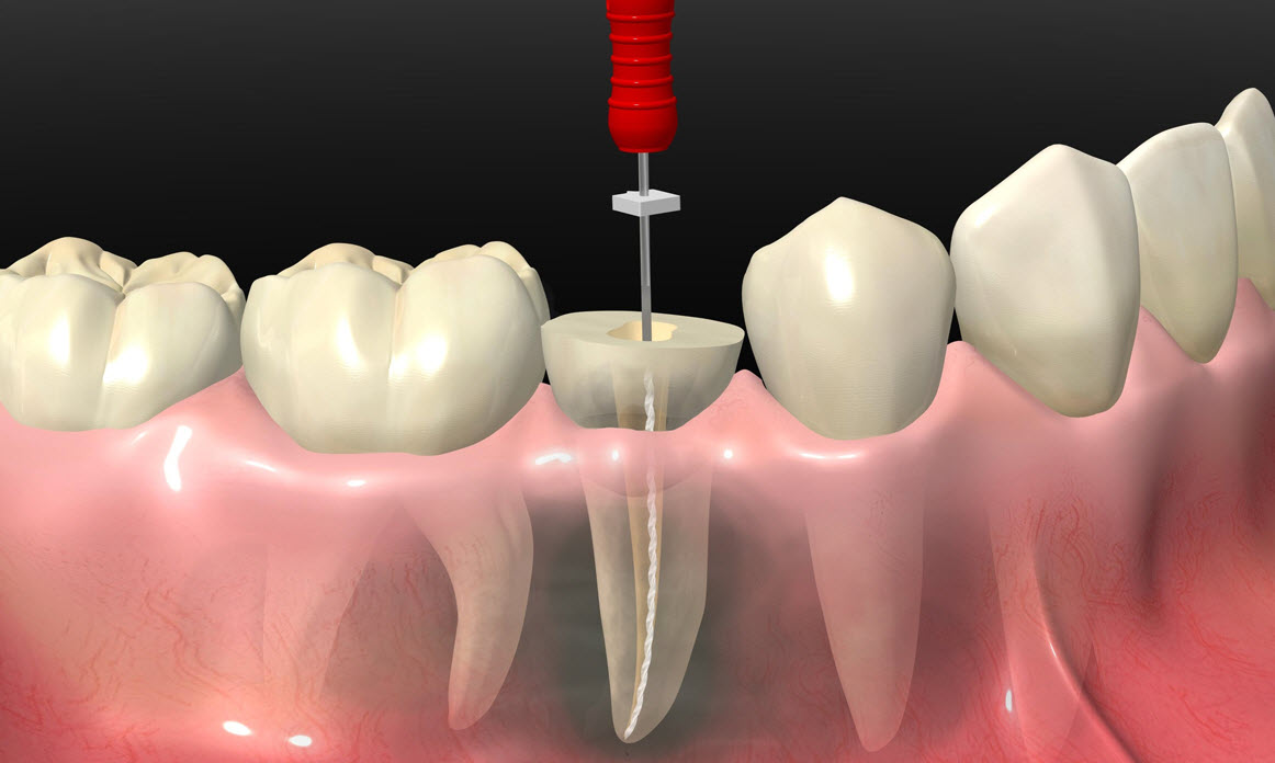 Пломбирование каналов зуба: от А до Я