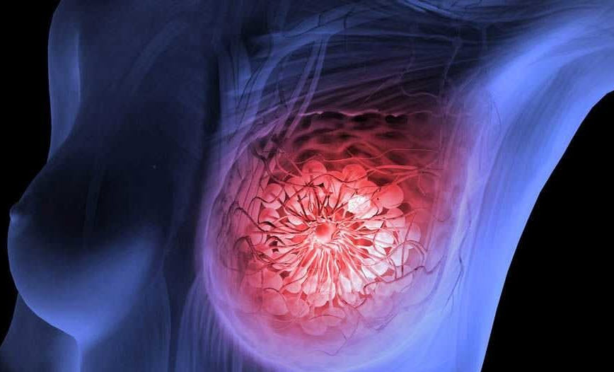 Рак молочной железы: как и почему возникает, чем проявляется