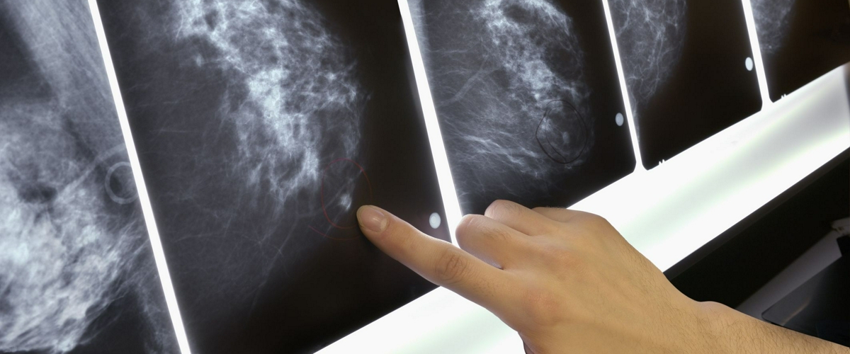 Как рак молочной железы выглядит на маммограмме?