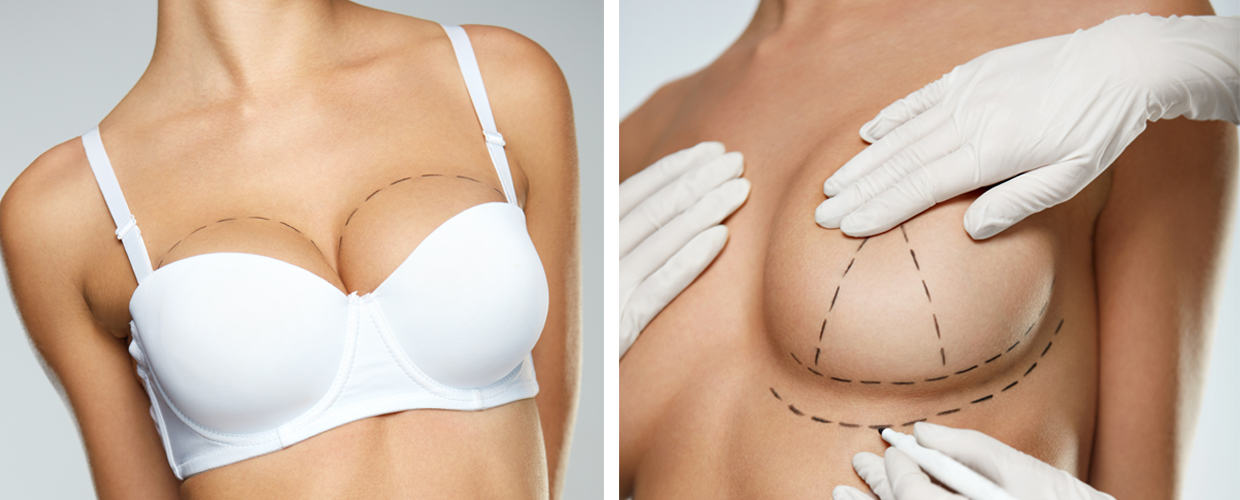 Подтяжка груди: кому показана, эффект и результат