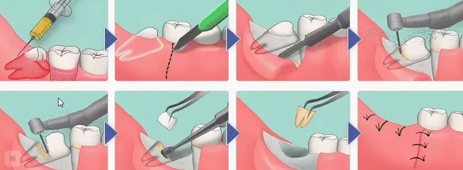 Удаление зубов любой сложности в Тамбове. Клиника Авонстом