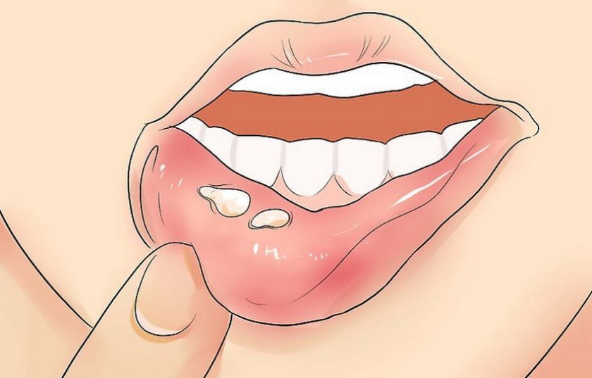 Язвы во рту: распространенные причины, способы лечения и препараты